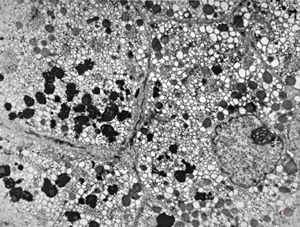 M,17y. | hyperbilirubinaemia - lipofuscin - Gilbert or Dubin-Johnson syndrome M,17y. | hyperbilirubinaemia - lipofuscin - Gilbert or Dubin-Johnson syndrome